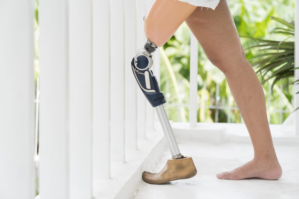 A close-up view focusing on a modern above-knee prosthetic leg as a person stands near a white railing.