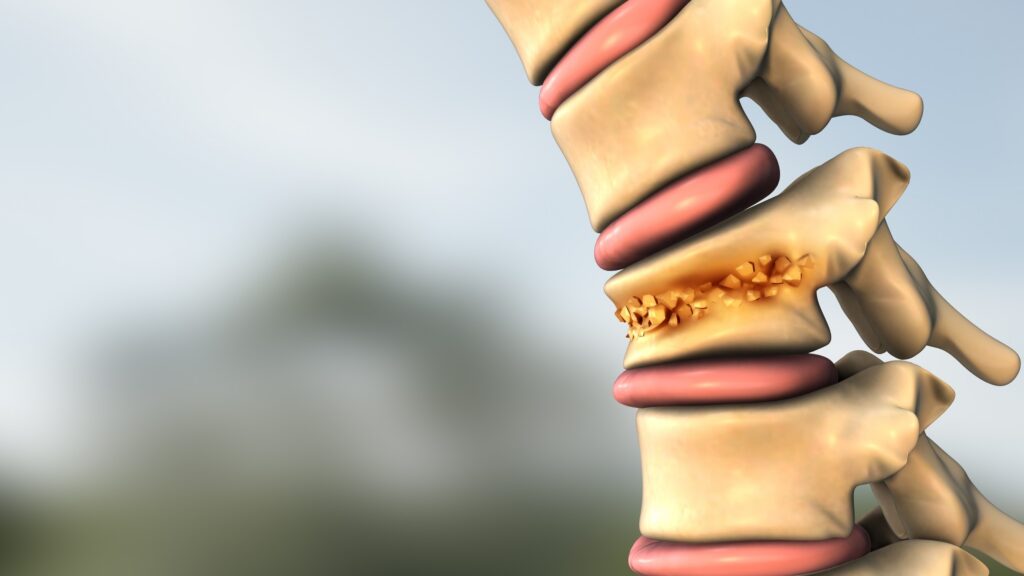 A 3D medical illustration of a human spine showing a fractured and crumbling vertebra between healthy intervertebral discs.